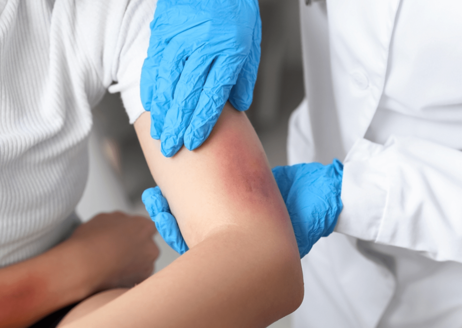 Bruised arm held by doctor