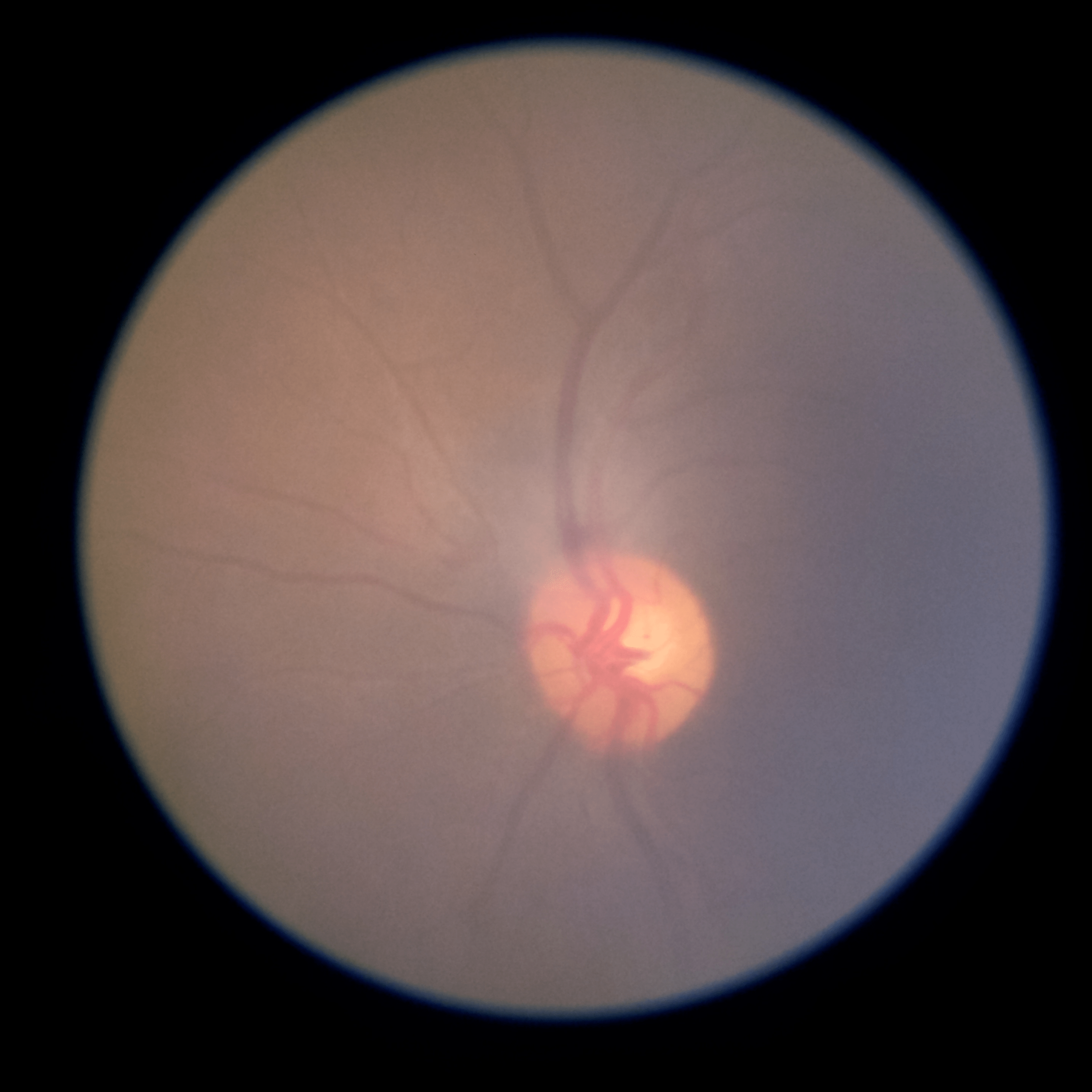 fundus NG